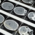 Revolução na Tecnologia Neural: A Jornada de Noland Arbaugh com o Implante Cerebral da Neuralink